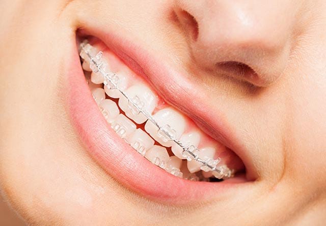 Ceramic Braces in Lansing & DeWitt, MI - West Family Orthodontics