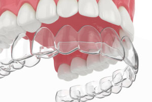 Three Reasons to Avoid Mail-Order Aligners