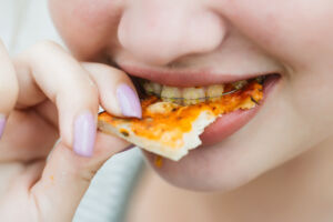 Summer Snacking with Braces: Healthy Choices for Patients with Braces