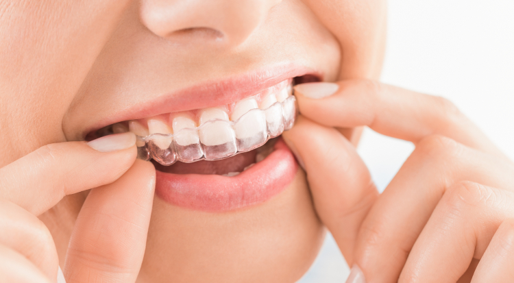 How Invisalign Works Step-by-Step